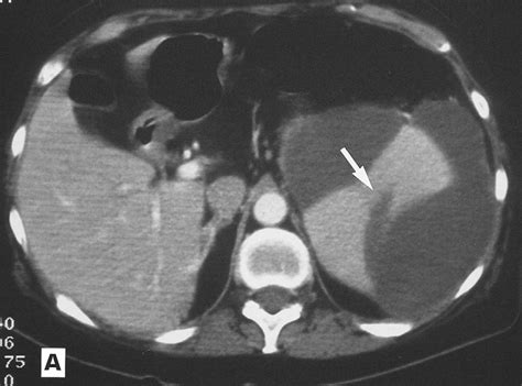 Subphrenic Abscess And Rupture Of The Spleen The Lancet