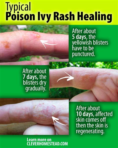 How To Heal Poison Ivy Rash