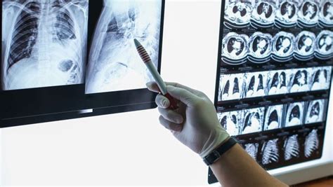 Disparities In Lung Cancer Screening Eligibility Still Exist Mdnewsline