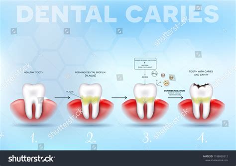 Tooth Decay Dental Caries Formation Detailed Diagram From Healthy