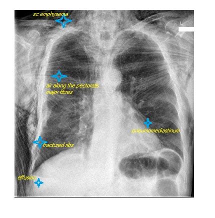 Imaging Case Of The Week Answer Emergucate