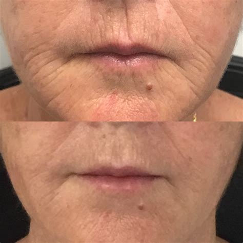 Laser Lip Lines Treatment Laser Fillers For Lip Wrinkle Smokers Lines