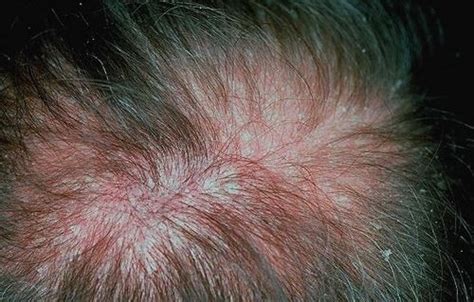 Folliculitis Seborrheic Dermatitis Red Spots On Scalp Javsystema