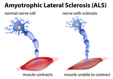 Amyotrophic Lateral Sclerosis Als 7 Official Symptoms