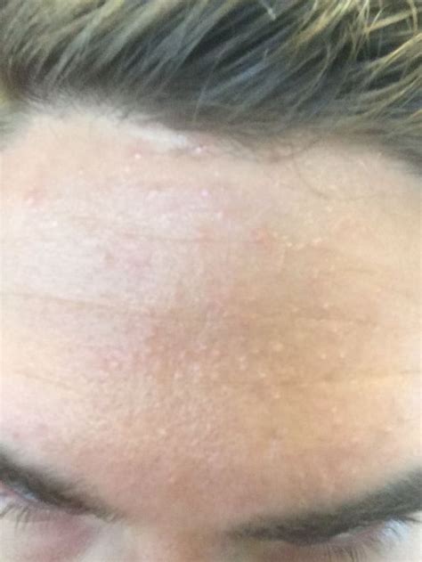 Skin Concerns Lot Of Bumps On My Forehead Is It Purging Or Break Out