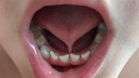 Floor Of Mouth Swollen On One Side Review Home Co