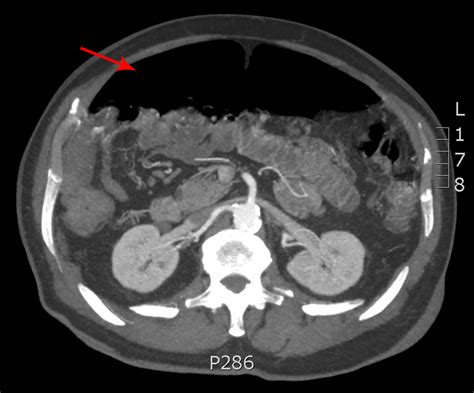 Cureus Small Bowel Diverticulosis As A Cause Of Chronic Pneumoperitoneum