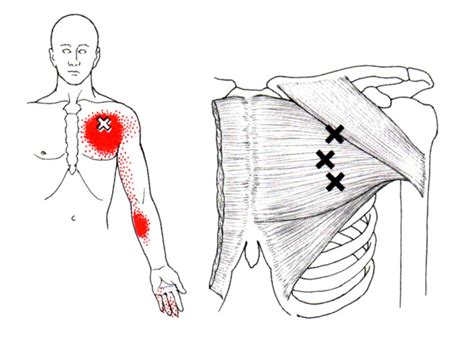 Serratus anterior muscle — located on the side of the chest along the ribs. Pectoralis Major 2 - The Orthopaedic Therapy Clinic