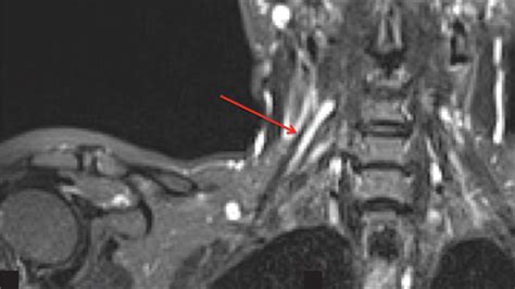 Lateral Femoral Cutaneous Nerve Mri