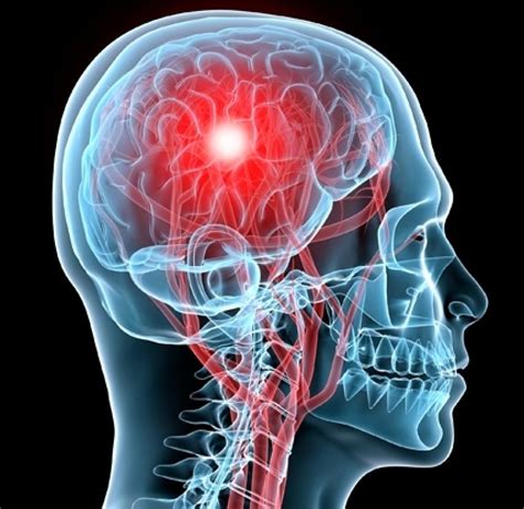 Concussions Classification And Management