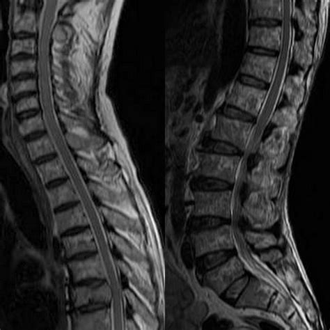 Clinical review and diagnostic imaging. Dr Balaji Anvekar FRCR: Multiple Myeloma MRI Spine