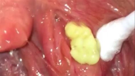 Tonsil Stones Symptoms Causes And Associated Complications