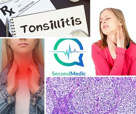 Tonsillitis Causes Symptoms Diagnosis And Treatment