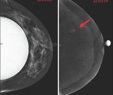 Study Highlights Use Of Contrast Enhanced Mammography In Women With