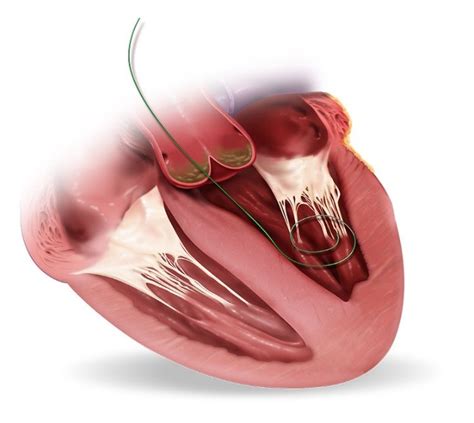 Corevalve Evolut Pro Клапан аортальный для транскатетерной установки