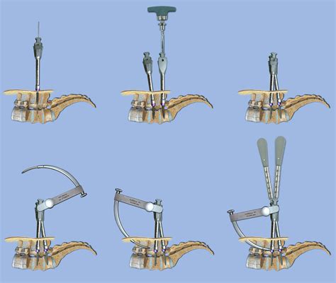 Minimally Invasive Spine Surgery Upmcspinespecialists