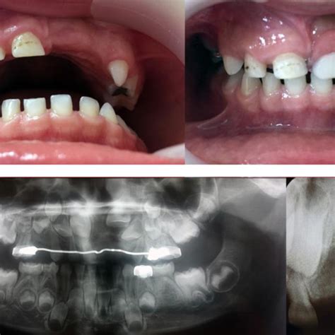 A Nance Esthetic Appliance B One Year Post Operative Radiograph