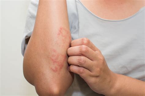 Eczema Vs Dermatitis Whats The Difference Skinmindbalance
