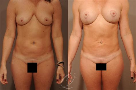 Breast Augmentation With Lift Before After Photos Patient 1528