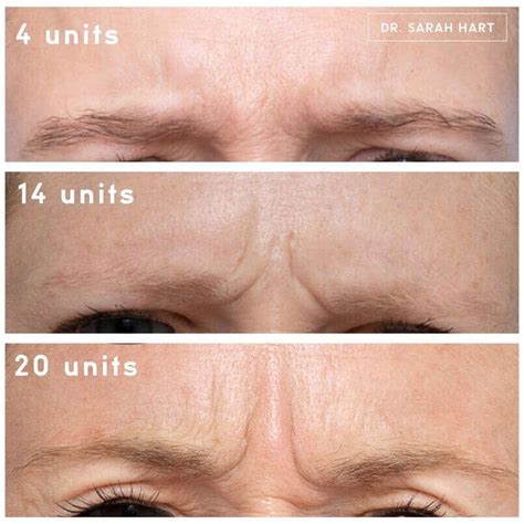 How Many Units Of Botox For Forehead First Time Cosmetic Surgery Tips