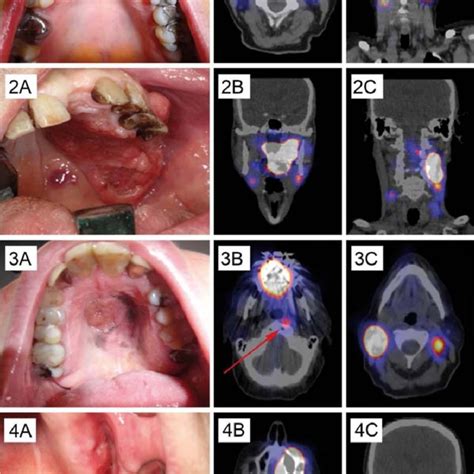 Pdf Lymphatic Drainage Patterns Of Oral Maxillary Tumors