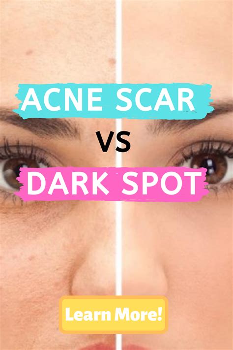 What Is The Difference Between An Acne Scar And A Dark Spot This Is