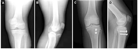 A Plain Radiograph Ap View Of A 14 Year Old With Type Iiib Tibial