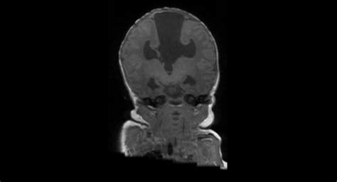 Joubert Syndrome With Schizencephaly And Posterior Fossa Cyst Image