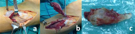 Intraoperative Views Of The Patient A Deep Peroneal Nerve Beneath