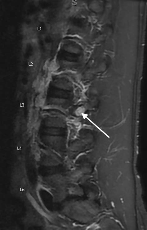 Lumbar Transverse Process Stress Fracture In An Elite Rower A Case