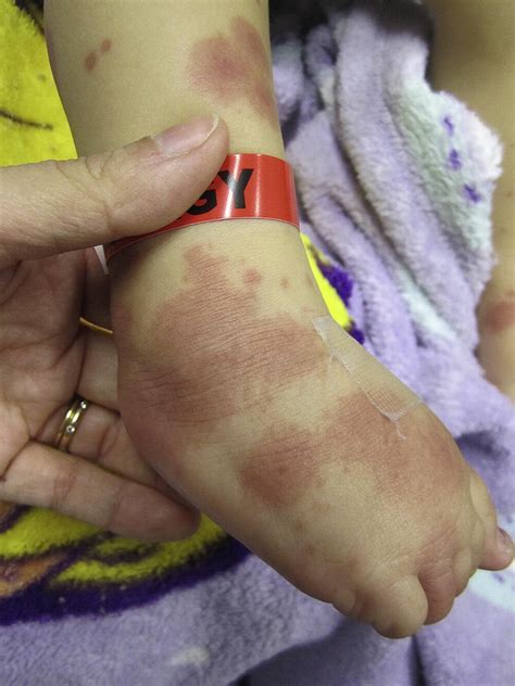 Acute Onset Of A Hemorrhagic Rash In An Otherwise Well Appearing Infant
