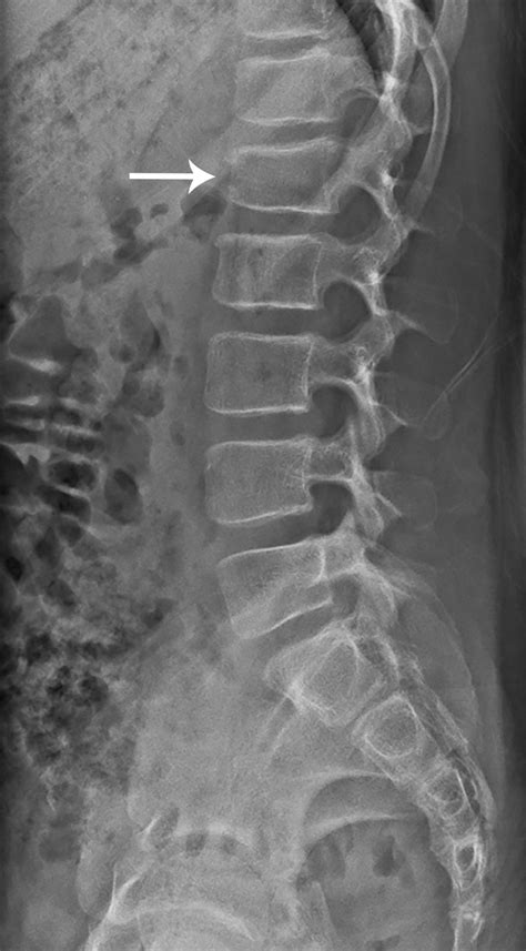 My Achin Back Vertebral Compression Fractures Radiology Key
