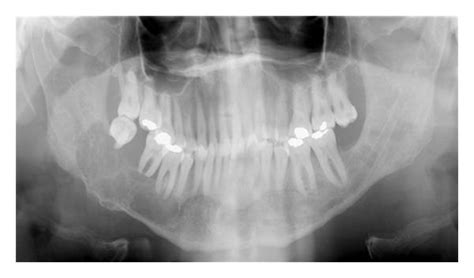 Panoramic Radiography Showing A Multilocular Radiolucency Of The Right