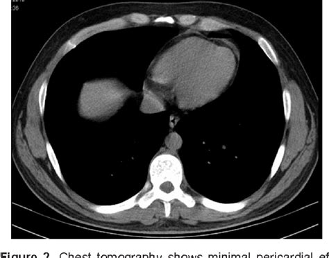 Figure 2 From A Case Of Viral Myocarditis Presenting With Acute Asthma