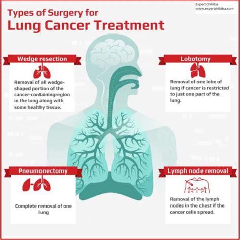 Lung Cancer Treatment And Surgery Cost In India Expert Chikitsa