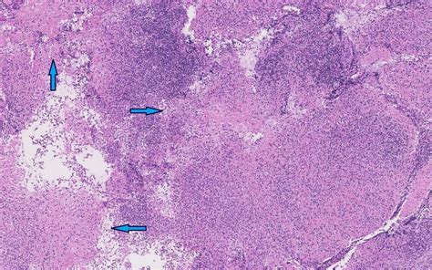 Kikuchi Fujimoto Disease A Rare Cause Of Cervical Lymphadenopathy And