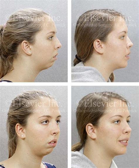 Long Face Growth Patterns Maxillary Vertical Excess With Mandibular Deformity Plastic Surgery Key