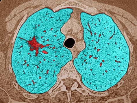 Small Cell Lung Cancer Ct Scan Stock Image C0522540 Science