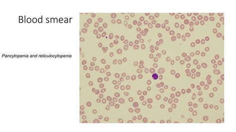 Case Study Aplastic Anemia