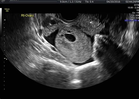 Assessing Ovarian Torsion Ultrasound Results For Diagnosis Empowered