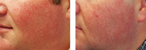 Rosacea Treatment Laser Treatment For Rosacea Us Dermatology Partners