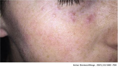 Granulomas In Dermatopathology Principal Diagnoses Part 1 Actas