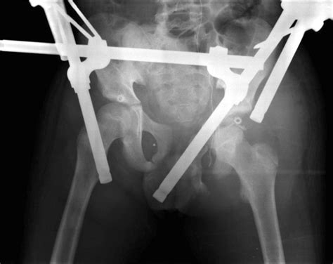 pelvic radiograph obtained after 31 days of hospitalization from the download scientific