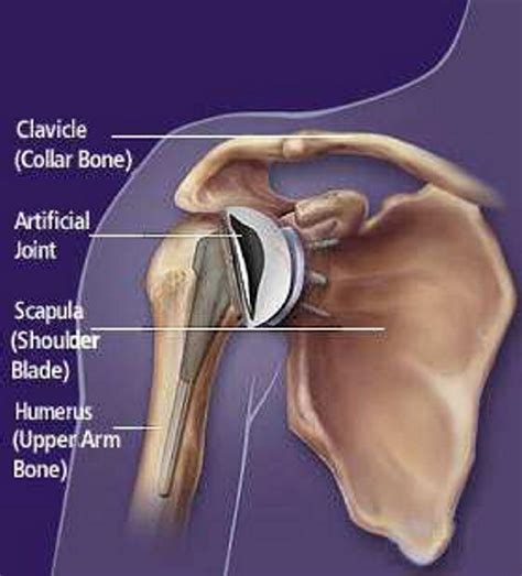 Shoulder muscles anatomy diagram shoulder muscle anatomy, shoulder anatomy, shoulder muscles. An example of a schematic of an artificial shoulder joint. | Download Scientific Diagram