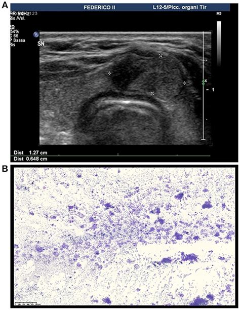 Isthmus Thyroid Nodule Pictures Science Transition