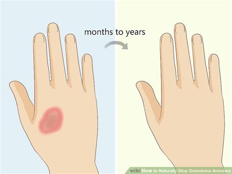 How To Stop Granuloma Annulare Can Natural Remedies Help