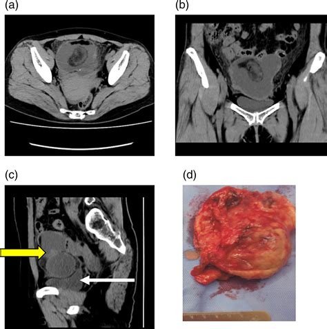 Malignant Transformation From Mature Cystic Teratoma Of The Ovary