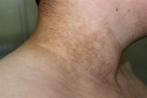 Dark Neck Causes Diagnosis Treatments And Remedies