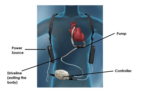Lvad Part I Introduction And Physical Exam