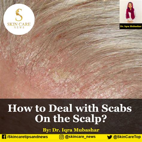 How To Deal With Scabs On The Scalp